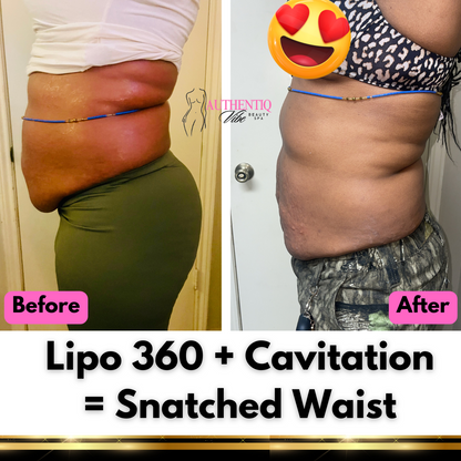 360 FAT REDUCTION + NEEDLE-FREE FAT DISSOLVE