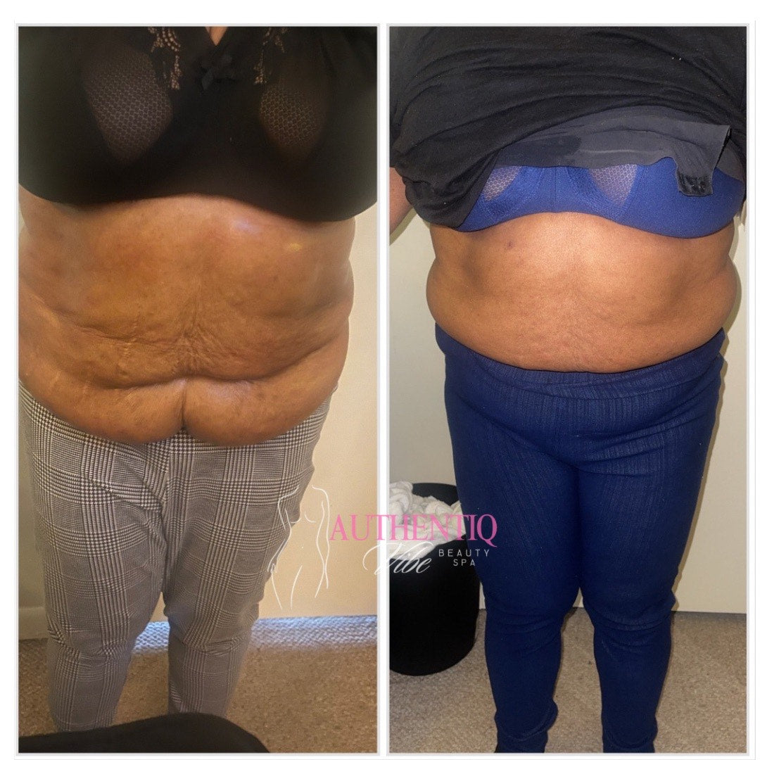 360 FAT REDUCTION + NEEDLE-FREE FAT DISSOLVE